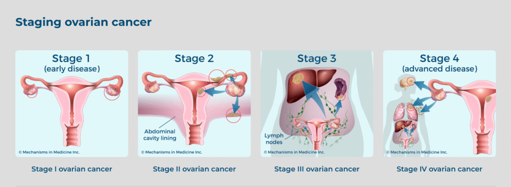 Stages of ovarian cancer