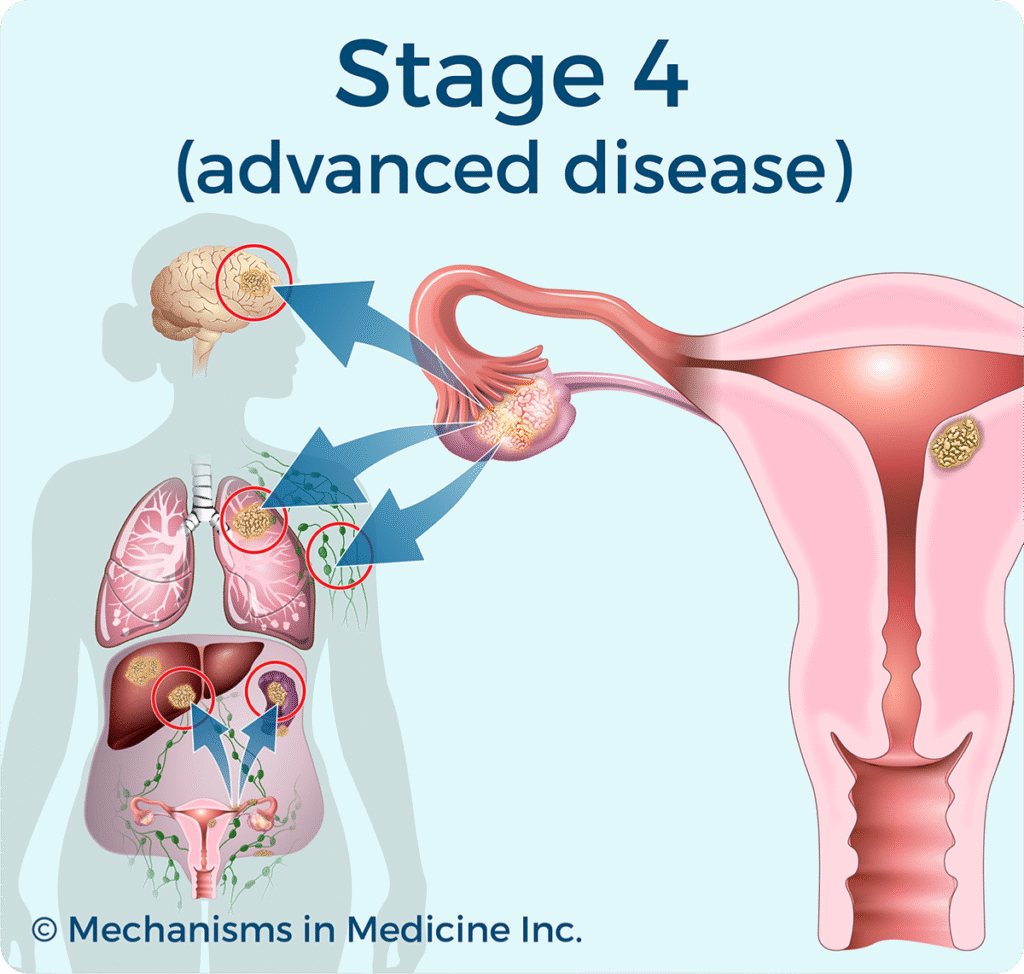 FIGO stage IV ovarian cancer