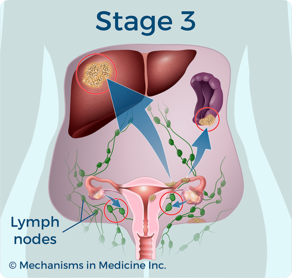 FIGO stage III ovarian cancer